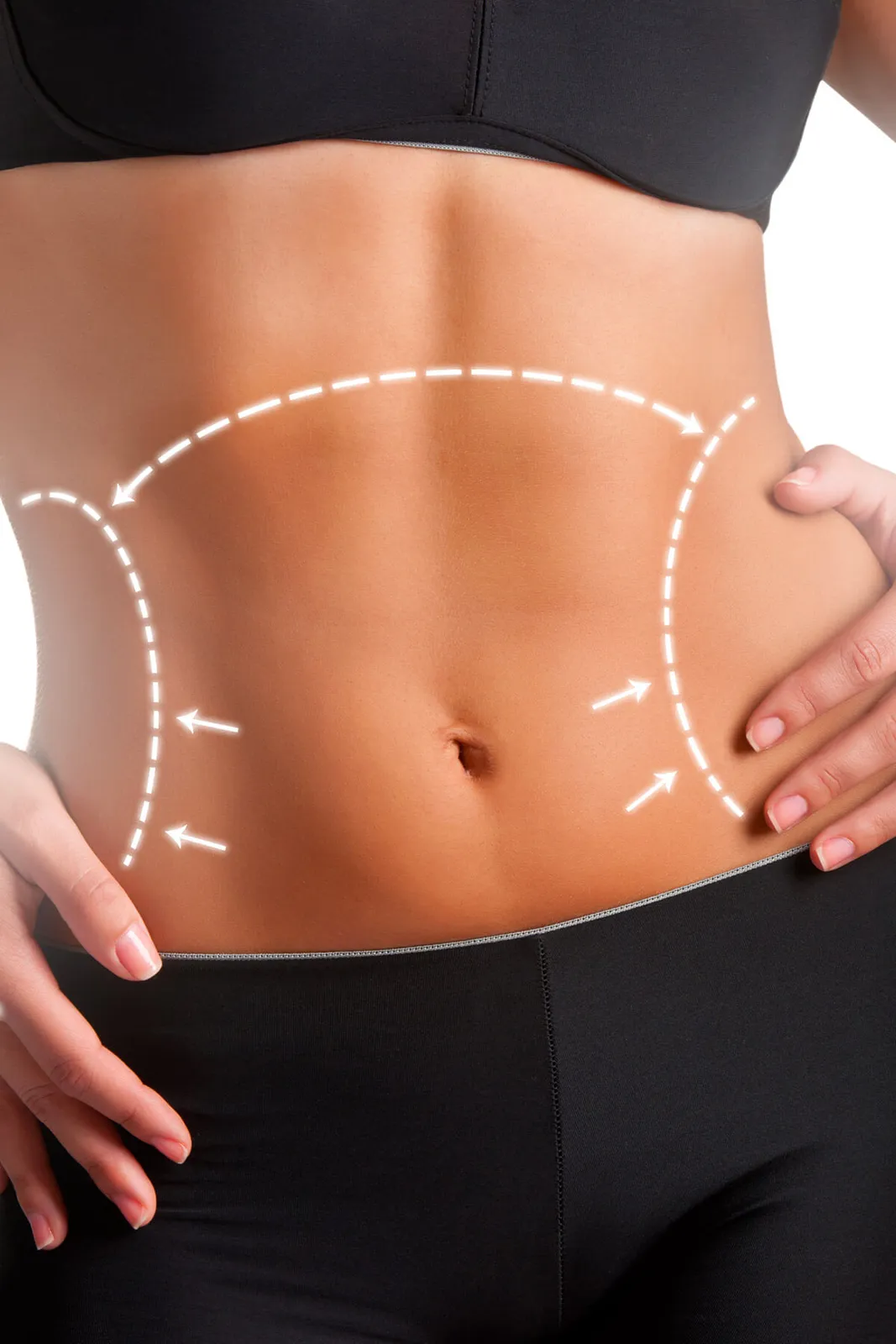 Belt lipectomy surgery