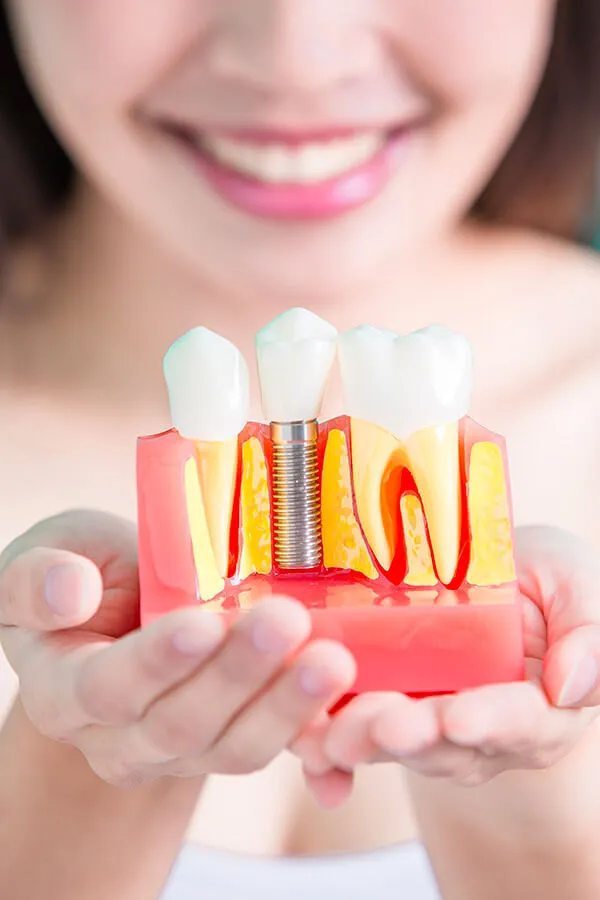 Single Dental Implant Procedure