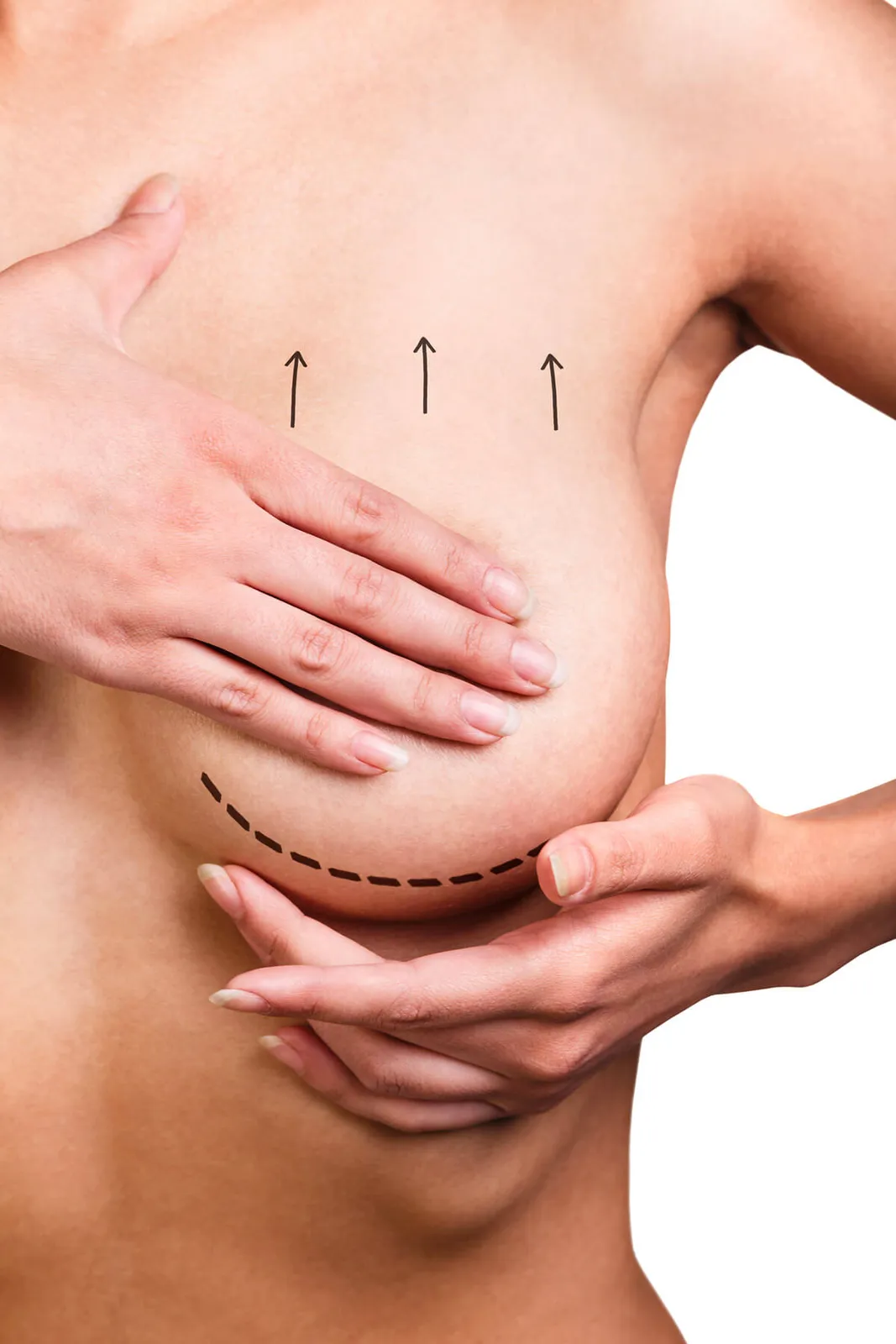 Breast lift surgery