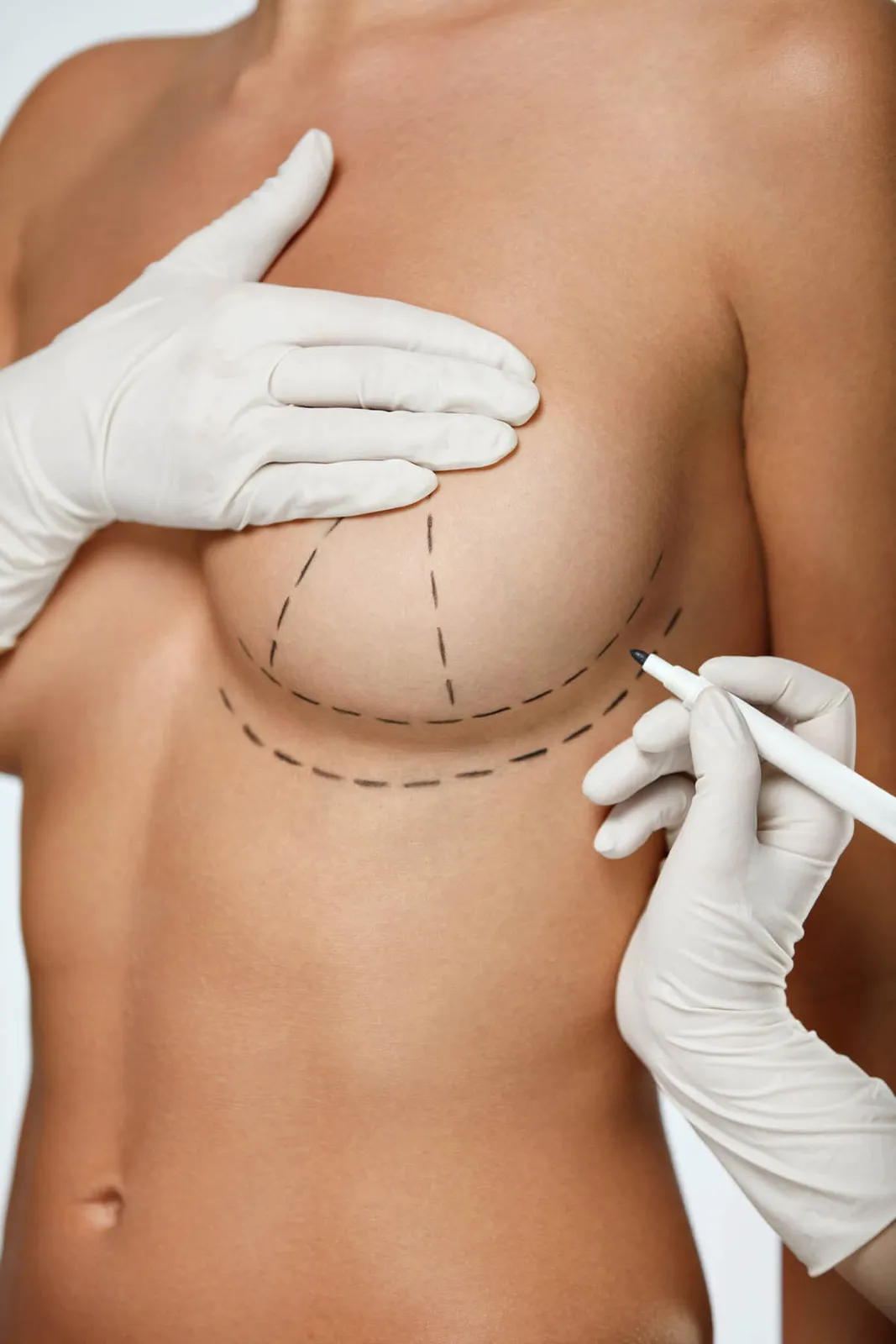 Breast revision surgery